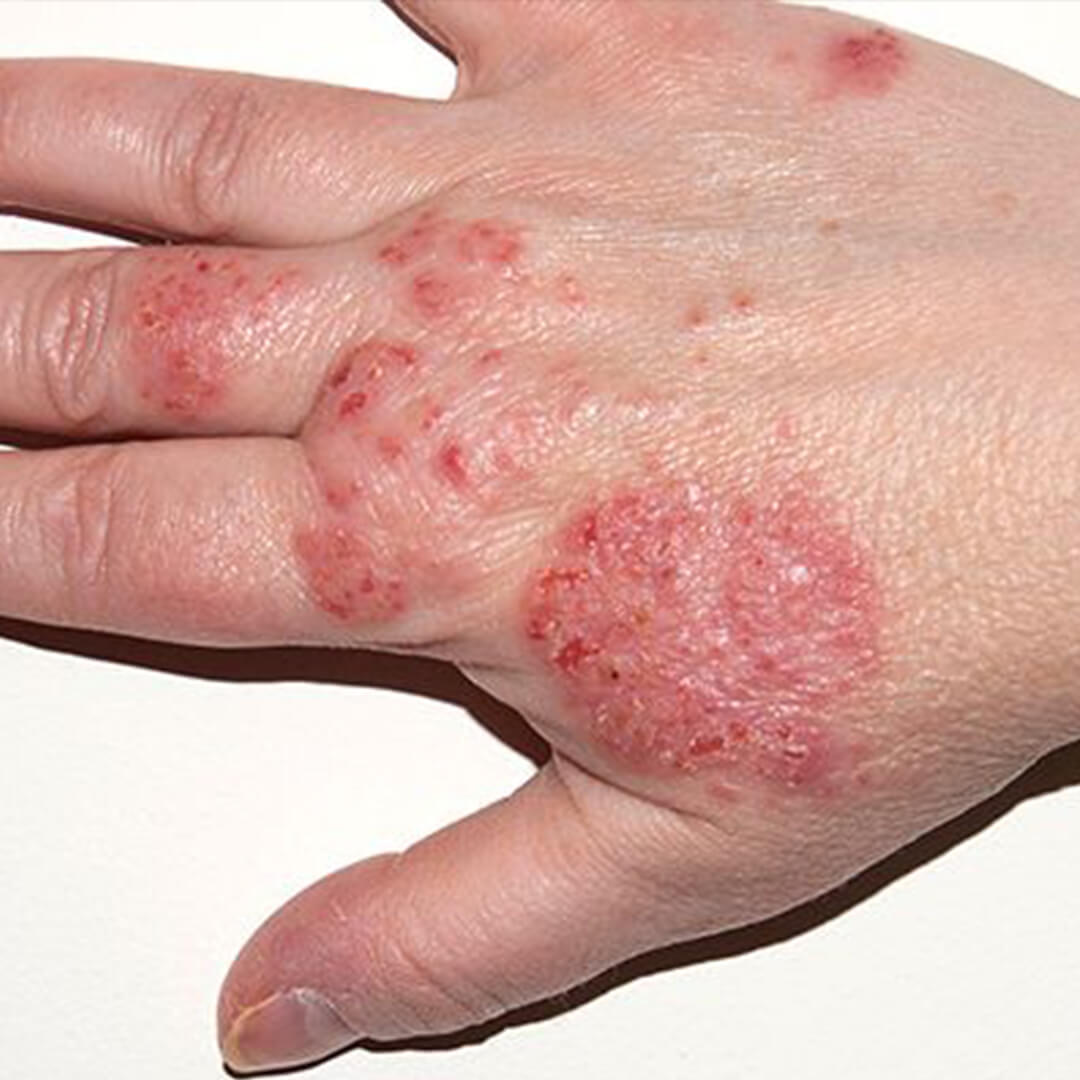Masalah Eczema adalah berpunca dari genetik, kesan pada kulit dlm jangka masa panjang adalah sgt buruk. Kulit sensitif, pedih, mengelupas, kering & gatal. Makin melarat kalau dibiarkan.